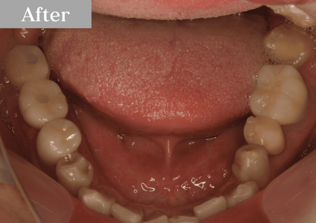 インプラントafter|たまプラーザのインプラント|dentalclinicCたまプラーザ