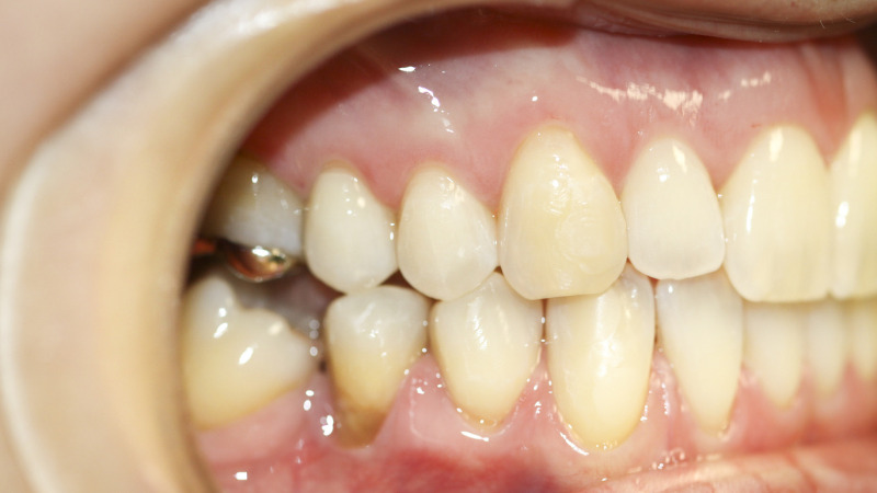 歯茎の腫れが治らない原因