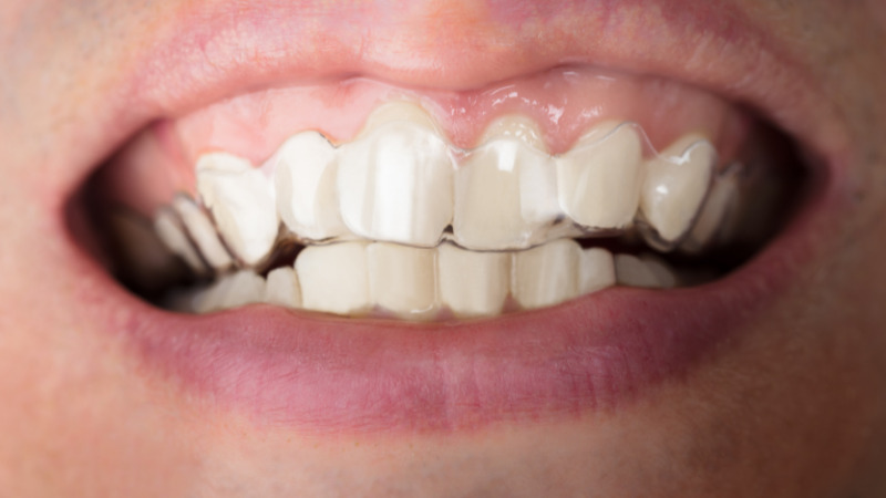 歯並びをきれいにする方法｜治療の種類・費用・期間を解説