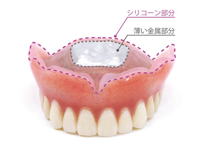コンフォート義歯|たまプラーザの歯医者・入れ歯dentalclinicCたまプラーザ
