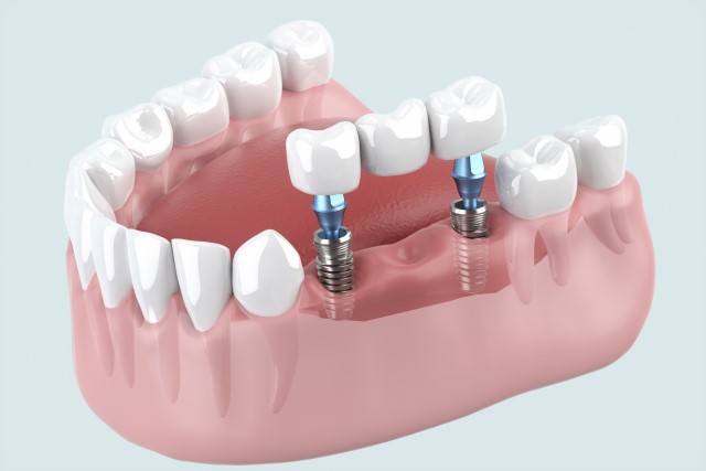 ブリッジとは?|たまプラーザの歯医者・入れ歯dentalclinicCたまプラーザ