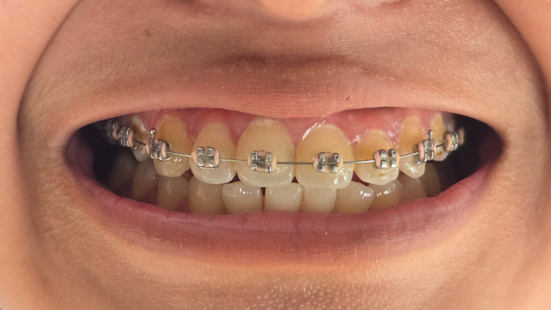 歯並びがガタガタ（叢生）の原因・症状・矯正治療を解説