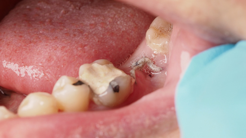 歯茎の腫れが治らない原因